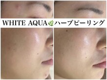 ホワイトアクア 鳳店(WHITE AQUA)/ハーブピーリング/毛穴/大阪/鳳