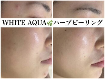 ホワイトアクア 鳳店(WHITE AQUA)/ハーブピーリング/毛穴/大阪/鳳