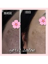 ヨリーズサロン(yoris.salon)/シミ　くすみもお任せください♪