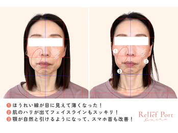 リリーフポート フェミナ鍼灸整体院 大濠公園店/1回の電気美容鍼で圧倒的な変化