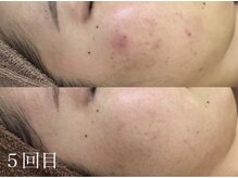 アワピール 天王寺店(AWA PEELL)/ハーブピーリング/毛穴/天王寺