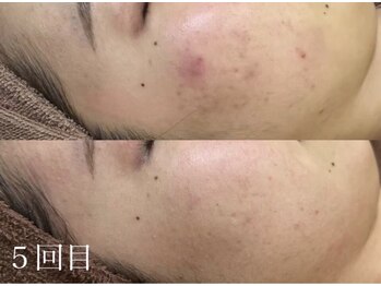 アワピール 天王寺店(AWA PEELL)/ハーブピーリング/毛穴/天王寺