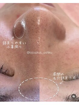ビジュープラス ひたち野うしく店(Bijou+)の写真/【茨城県初（株式会社スリーアール公式HPより/2023年）！韓国式3D毛穴洗浄導入店◎】SNSで話題のマシン♪