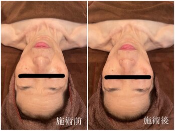 ハリキュア(H.a.r.i C.u.r.e.)/小顔フェイシャル、美容鍼