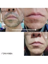 鍼灸整骨院しおん/ヒゲ脱毛