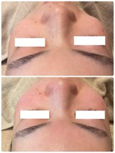 ディオーネ 春日井勝川店(Dione)/毛穴洗浄☆ビフォーアフター