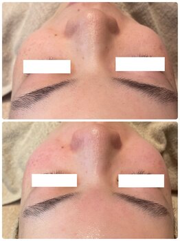 ディオーネ 春日井勝川店(Dione)/毛穴洗浄☆ビフォーアフター