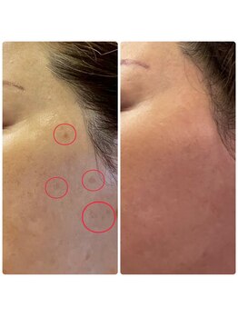 ジョルジオ東京/プラズマピーリング