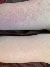 ルアナアイナ(Luana Aina)/二の腕ケア/ハーブピーリング