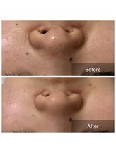 ラペ(la paix)/フェイス症例写真