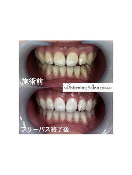 ホワイトニングサロン 京都烏丸店/ホワイトニング施術例