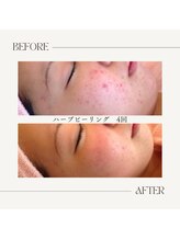 エンルーチェ プラスエイト(en;Luce+8)/生ハーブピーリング