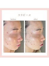 韓国肌管理yeoun【ヨウン】ROMAPINK/黒ずみ/毛穴/プラピール/ララピール福岡天神/ララピール/ララピール福岡