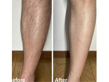 ビオエル(Bioel)/Before After