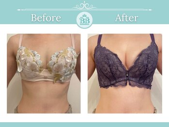 美人バスト 名古屋店/【バストアップ】症例