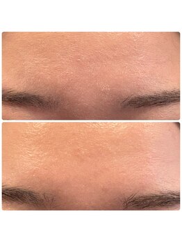 ジョルジオ東京/カーボンピーリング