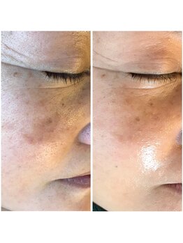 ココオーブ(COCO AUBE)/レーザー失敗の方にはハーブ