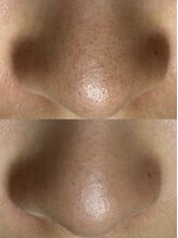 エヌ ドット ジュウイチ(N.11)/黒ずみ毛穴洗浄