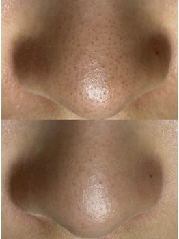 エヌ ドット ジュウイチ(N.11)/黒ずみ毛穴洗浄