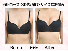 美人バスト リグラス(ReGrous)/バストアップbefore,after
