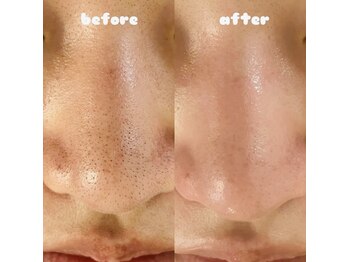 ティアラ(tiara)/毛穴汚れごっそり除去！毛穴洗浄