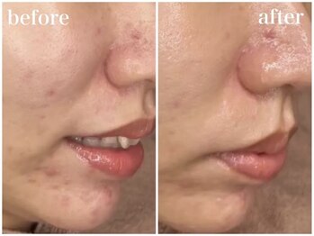 ホワイトアクア 鳳店(WHITE AQUA)/ララピール BeforeAfter