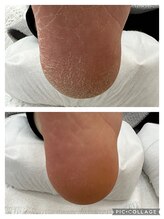 シーオングル(Siii ongle)/フット足裏角質ケア