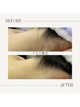 エンルーチェ プラスエイト(en;Luce+8)/うなじ脱毛