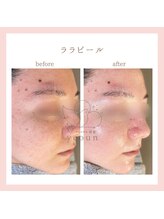 韓国肌管理yeoun【ヨウン】ROMAPINK/黒ずみ/毛穴/プラピール/ララピール福岡天神/ララピール/ララピール福岡