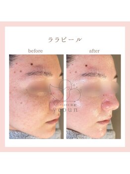 韓国肌管理yeoun【ヨウン】ROMAPINK/黒ずみ/毛穴/プラピール/ララピール福岡天神/ララピール/ララピール福岡