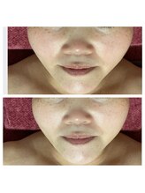 紫檀(シタン)/美肌♪小顔♪ハリ艶！