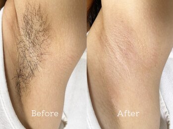 サーラ(SA-RA)/脇ワックス