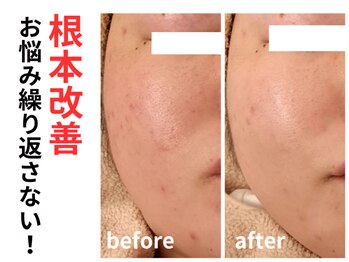 エリン(ERIN)/ハーブピーリング