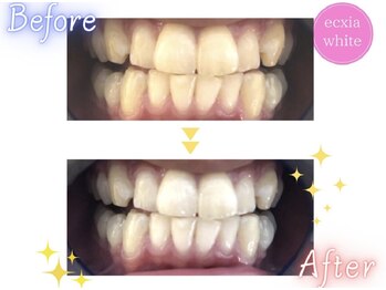 エクシアホワイト 浦安店/ホワイトニングビフォーアフター