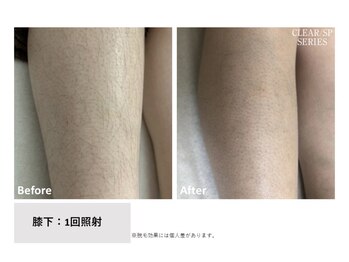 リネ(Rine)/before→after