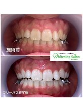 ホワイトニングサロン 名古屋駅店/【ホワイトニング施術例】