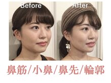 ラプリシュシュ 岡山店(Raplit)/隆鼻＋輪郭矯正40分10回