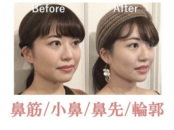 ラプリシュシュ 岡山店(Raplit)/隆鼻+輪郭矯正40分10回