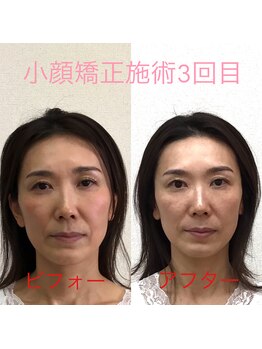 オズ六本木/六本木小顔矯正(整顔)施術3回