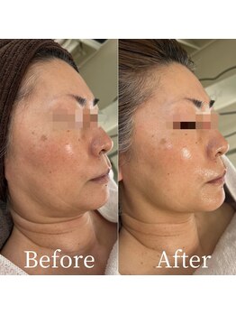 ユカリス(Yu.charis)/水光肌ミコステラ Before→After