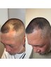 全世界で大注目！スカルプ　Uタイプ