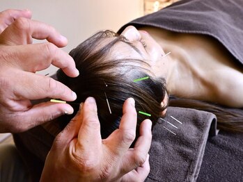 なごみやの写真/《効果の実感は感動級》睡眠不足/頭の疲れに☆頭鍼+ヘッドスパ+首肩ほぐし¥3,900