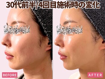 ベモーレ 谷町九丁目 上本町/30代プラズマ×幹細胞4回☆