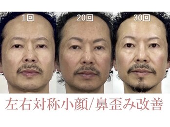 ラプリ 盛岡店(Raplit)/隆鼻＋輪郭矯正40分30回