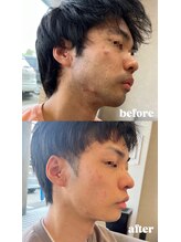 エクラ(ECLAT)/ヒゲ脱毛で劇的変化！