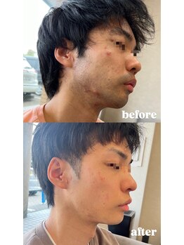 エクラ(ECLAT)/ヒゲ脱毛で劇的変化！