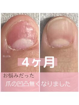 エルアンド(elle＆)/噛み爪さん4ヶ月で爪が変化