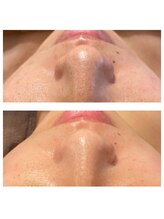 ビジュープラス 神栖店(Bijou+)/毛穴ケア・お肌のザラつき