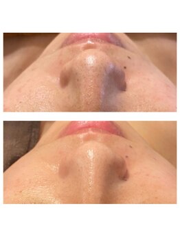 ビジュープラス 神栖店(Bijou+)/毛穴ケア・お肌のザラつき