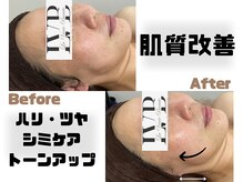 ラヴレボーテ(La Vraie Beaute)/ハーブピーリング2回